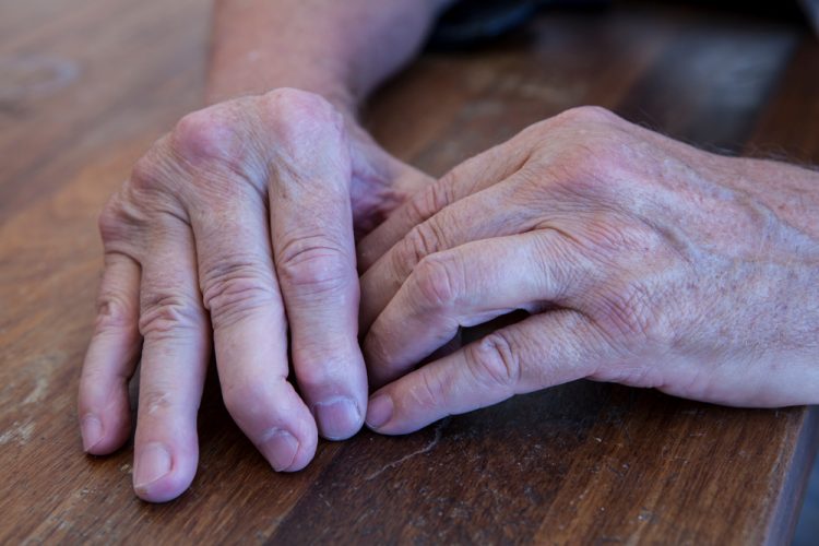 Hands of man with psoriatic arthritis