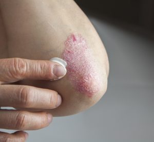 Elbow with plaque psoriasis