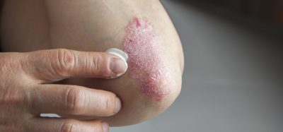 Elbow with plaque psoriasis