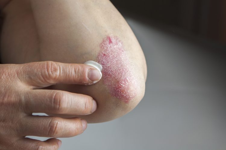 Elbow with plaque psoriasis