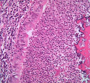 NICE cystic fibrosis