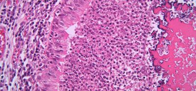 NICE cystic fibrosis