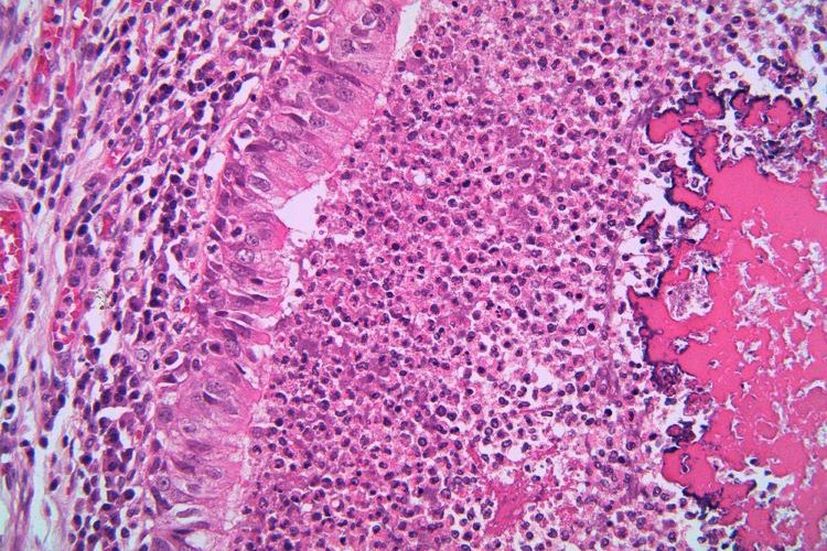 NICE cystic fibrosis