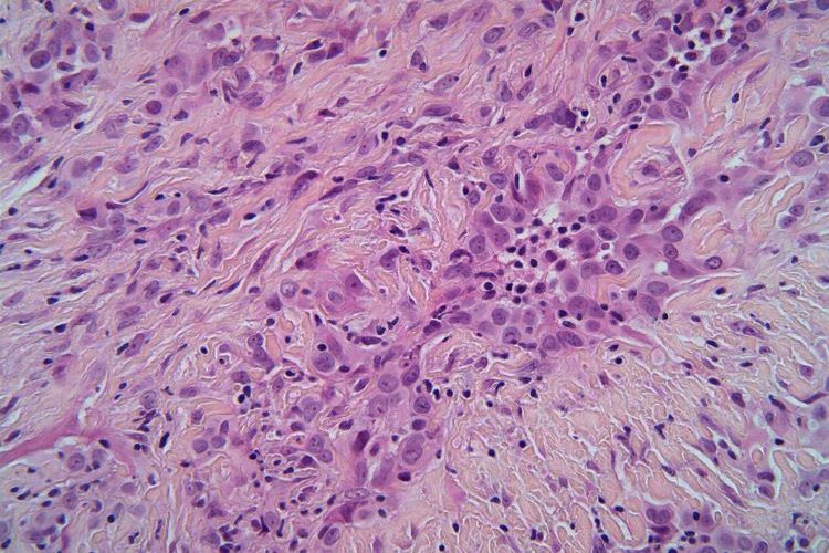 cancer treatment malignant pleural mesothelioma