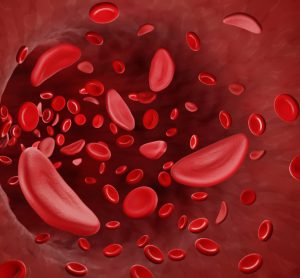 Sickle cells in blood stream