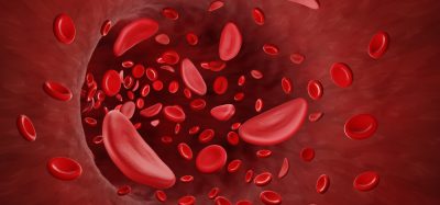 Sickle cells in blood stream