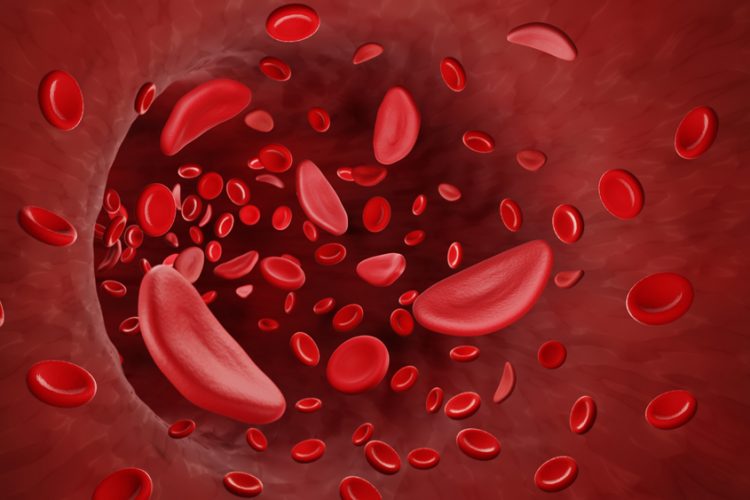 Sickle cells in blood stream