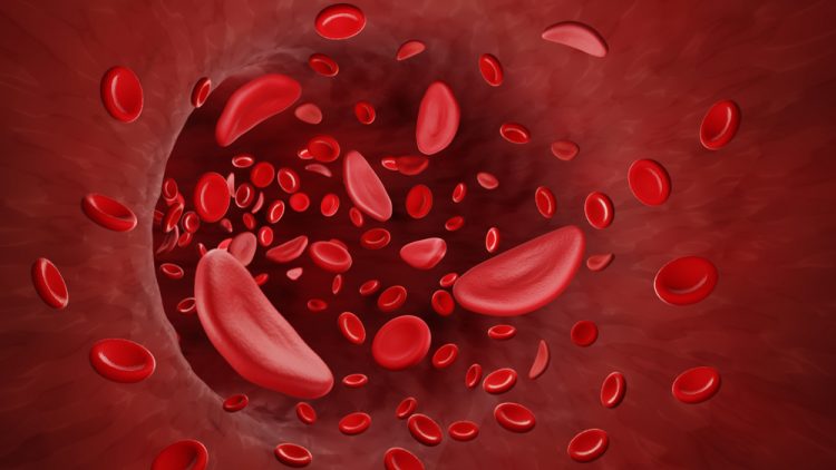 Sickle cells in blood stream