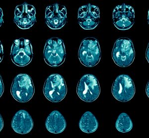 MRI of brains with metastasis
