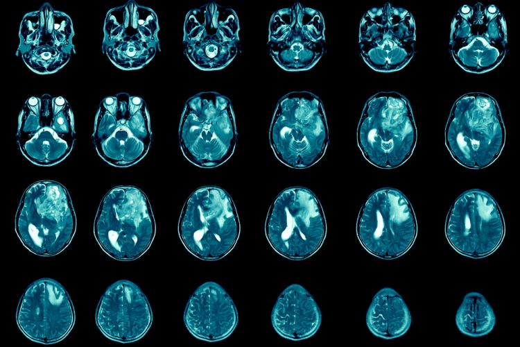 MRI of brains with metastasis