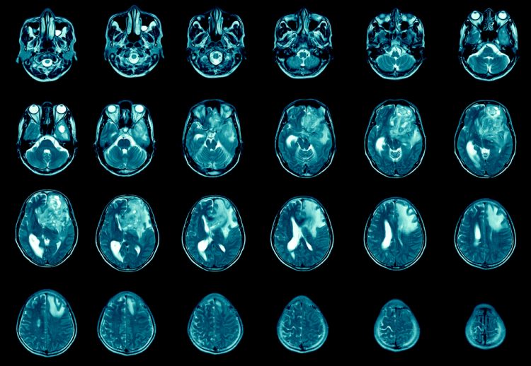 MRI of brains with metastasis