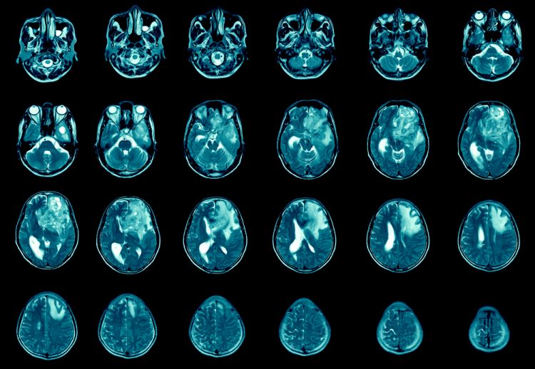 MRI of brains with metastasis