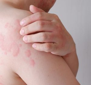 Dupixent FDA FDA chronic spontaneous urticaria