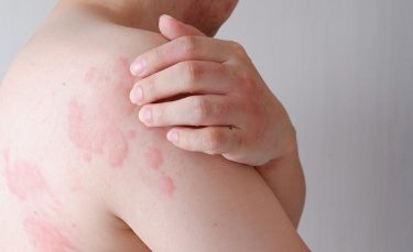 Dupixent FDA FDA chronic spontaneous urticaria
