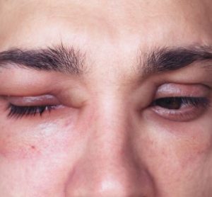 FDA hereditary angioedema