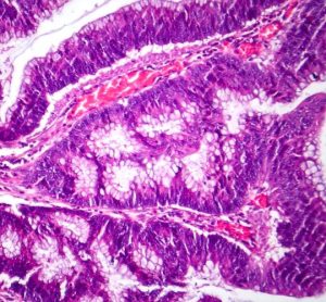 radiopharmaceutical therapy adenocarcinoma