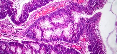 radiopharmaceutical therapy adenocarcinoma