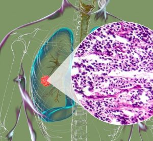 tumour-infiltrating lymphocyte (TIL) therapy TIL immunotherapy CD40L