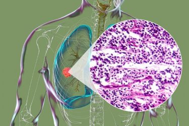tumour-infiltrating lymphocyte (TIL) therapy TIL immunotherapy CD40L