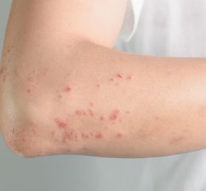 atopic dermatitis AbbVie