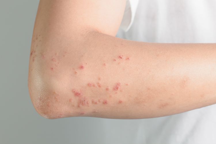 atopic dermatitis AbbVie