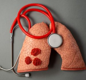 tuberculosis