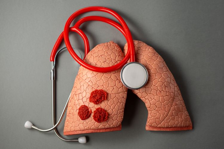 tuberculosis