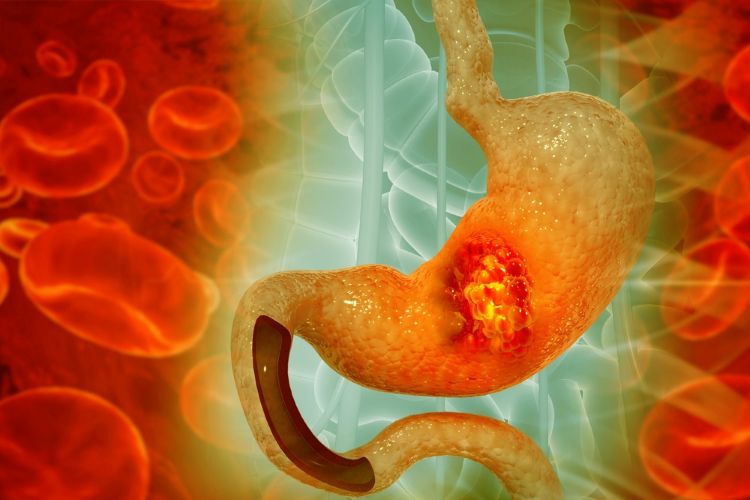 AstraZeneca’s Imfinzi plus chemotherapy earns CHMP nod in gastric cancer