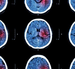 New technology could dramatically shorten diagnosis time of stroke patients