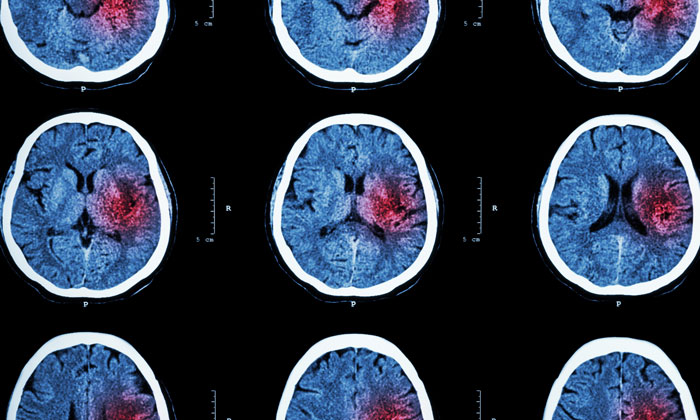 New technology could dramatically shorten diagnosis time of stroke patients