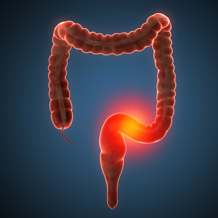 Treating ulcerative colitis with a safe and effective biologic