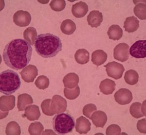 chronic lymphocytic leukaemia