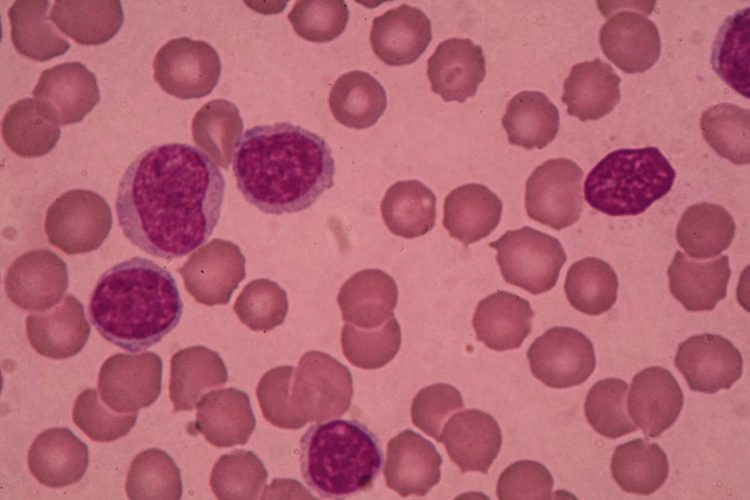 chronic lymphocytic leukaemia