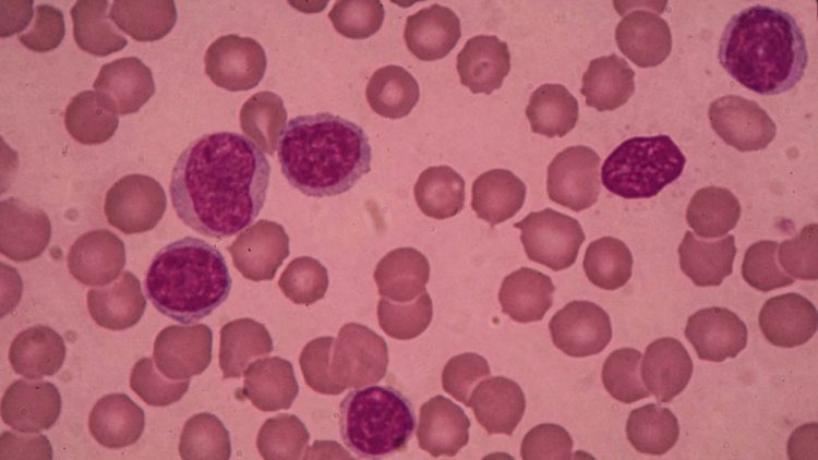 chronic lymphocytic leukaemia