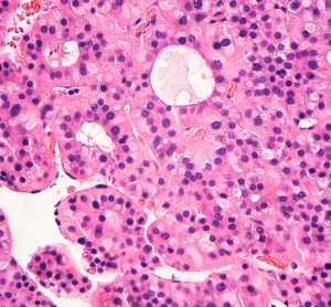 Hepatocellular Carcinoma (HCC)