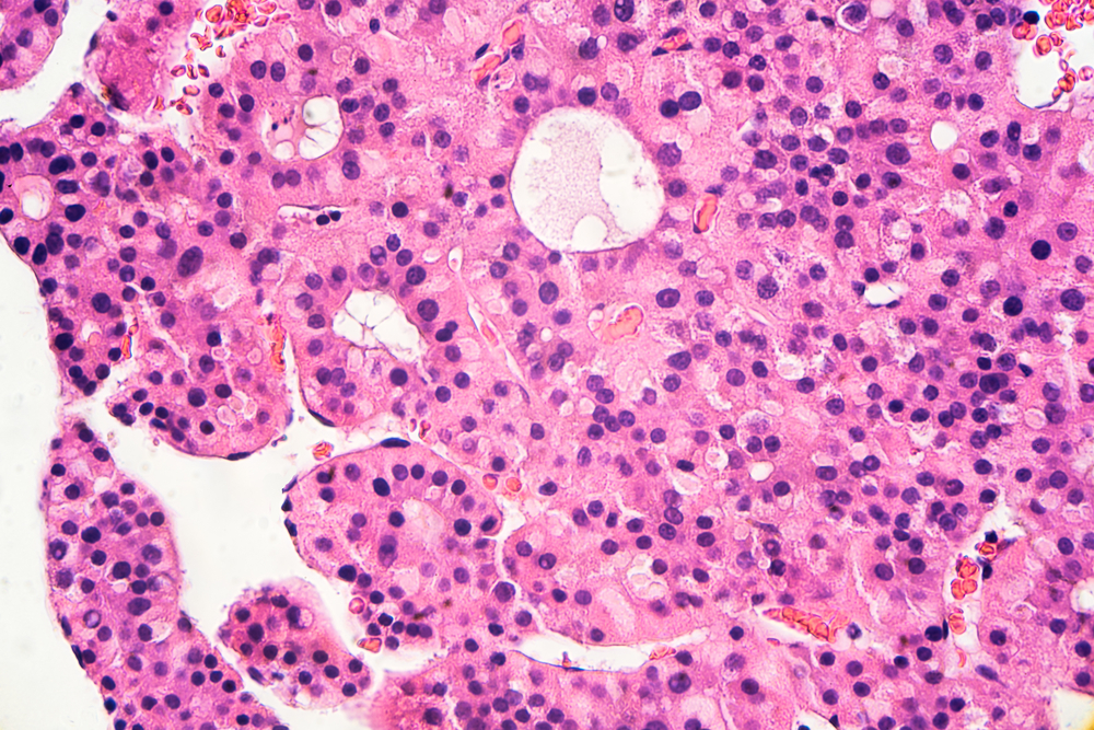 Hepatocellular Carcinoma (HCC)