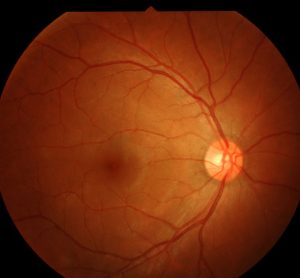 retinitis pigmentosa