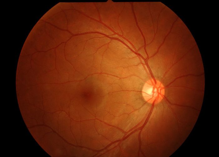 retinitis pigmentosa