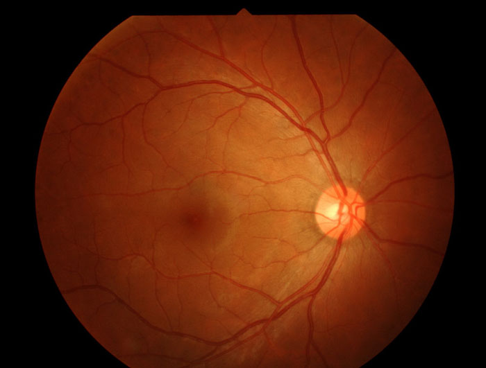 retinitis pigmentosa