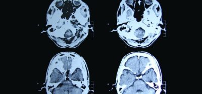 Huntington's gene therapy