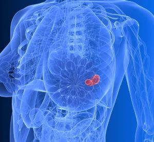 MHRA authorises new breast cancer therapy