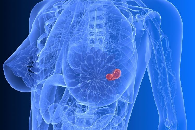 MHRA authorises new breast cancer therapy