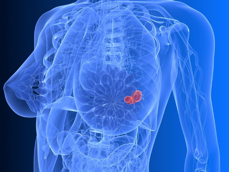 MHRA authorises new breast cancer therapy