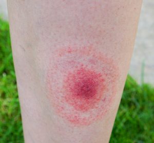 New Lyme disease tests could offer quicker, more accurate detection