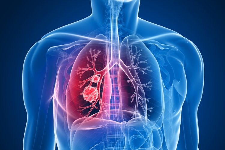 NSCLC - Trabecta treatment