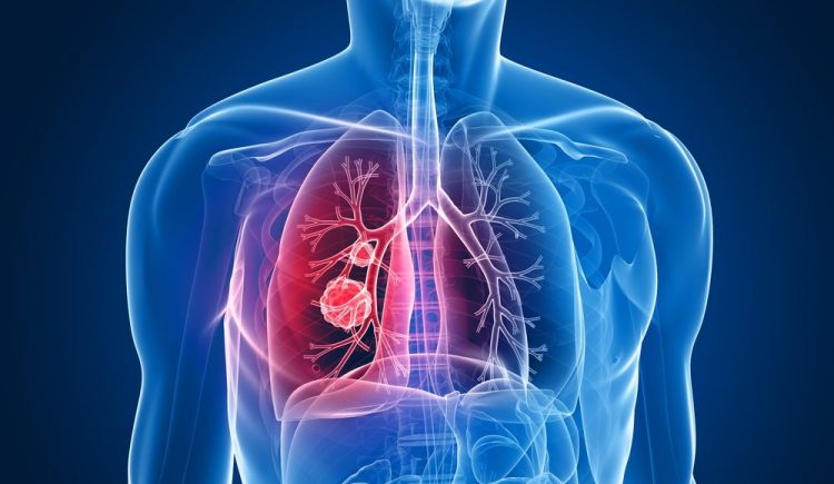 NSCLC - Trabecta treatment