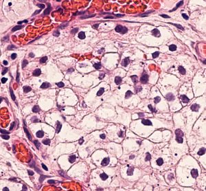 Renal cell carcinoma