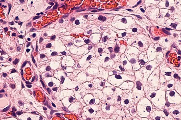 Renal cell carcinoma