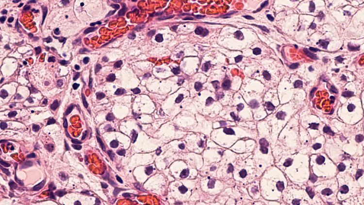 Renal cell carcinoma