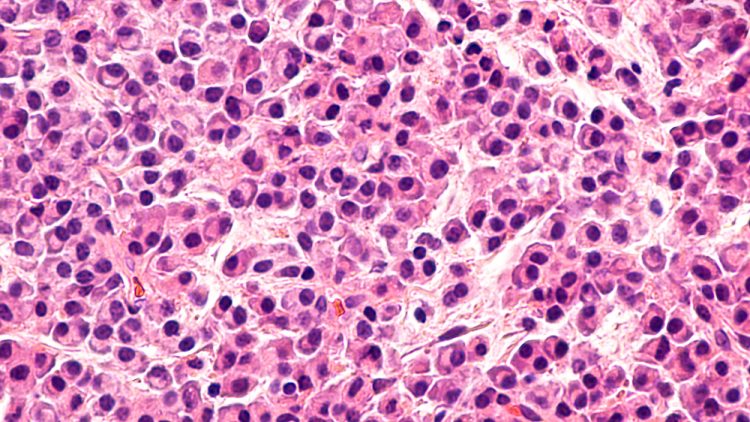 Microscopic image of multiple myeloma